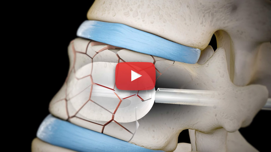 Kyphoplasty Interventional Spine & Pain Management Encinitas, CA.